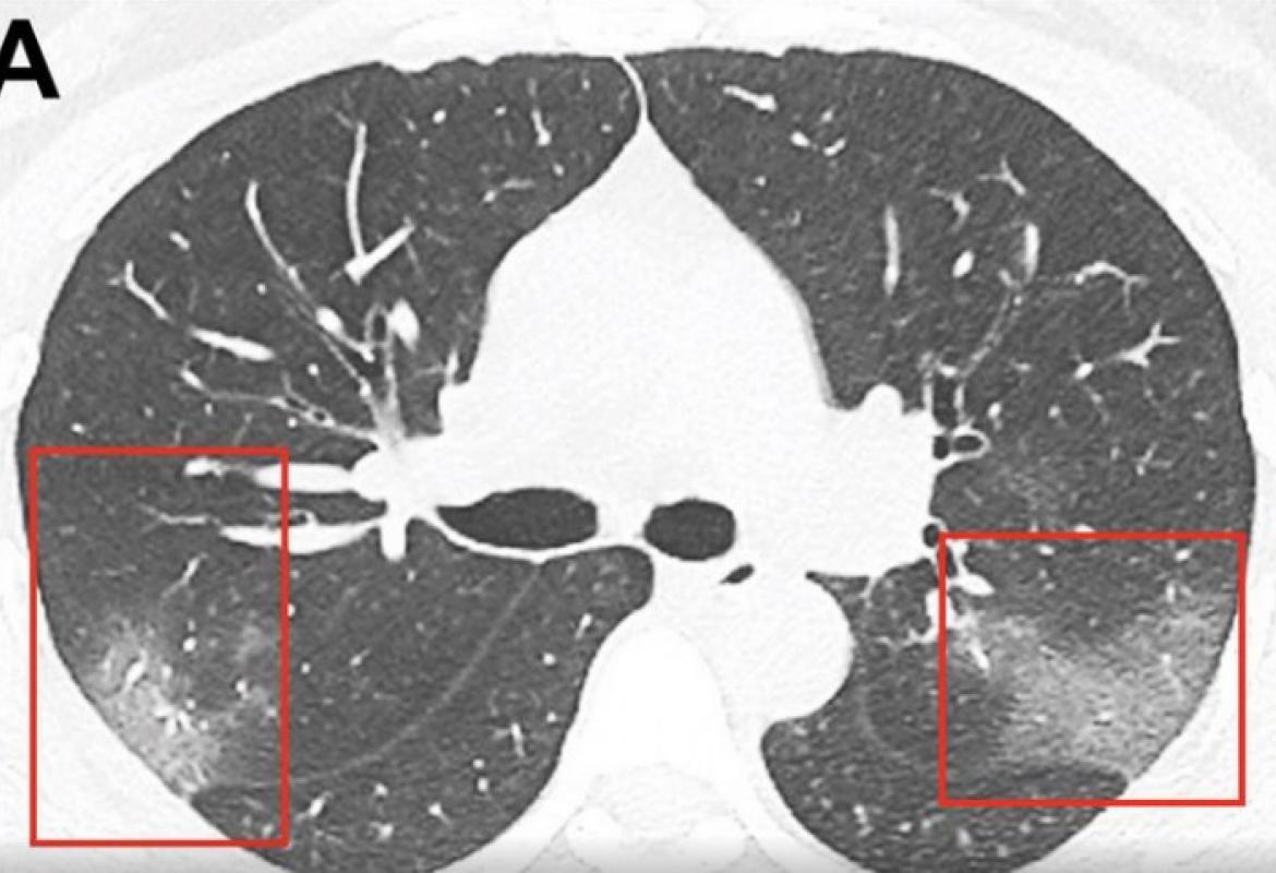 pluća-koronavirus 